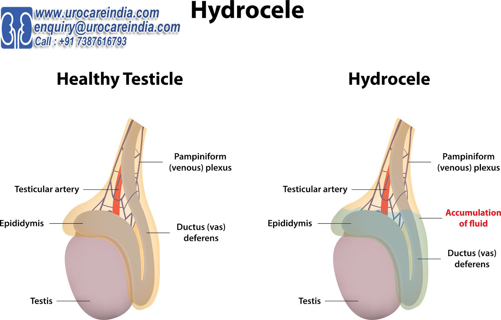 Hydrocele Operation in India At Affordable Cost- Hydrocele Operation
