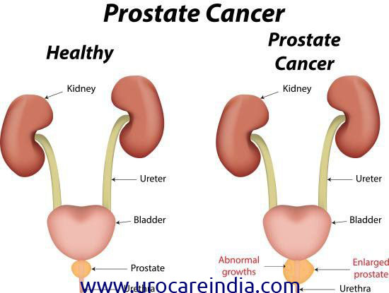 Natural Remedies for Prostate Cancer