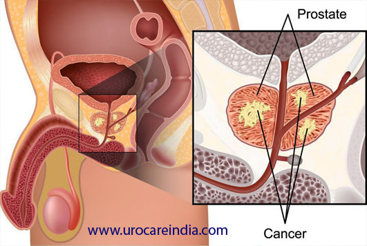 Means for Dealing With Prostate Cancer; Prostate Treatment and or Prostate Surgery