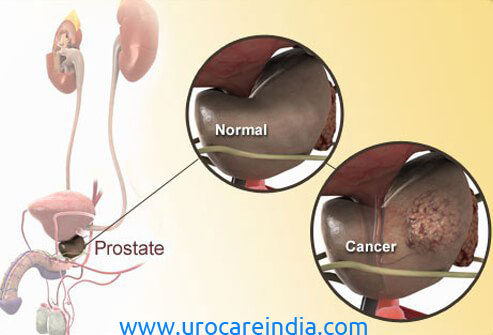 Advice to Prostate Cancer Victims
