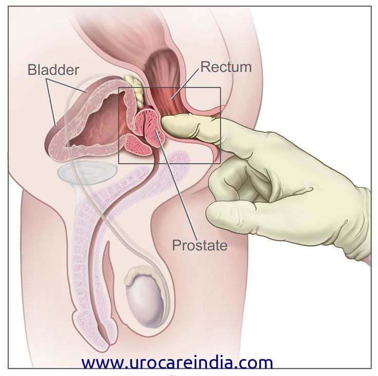 Prostate Imaging: The Visual Prostate Exam