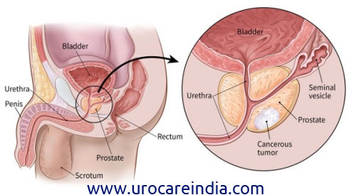 The Effects of Obesity on Prostate Cancer
